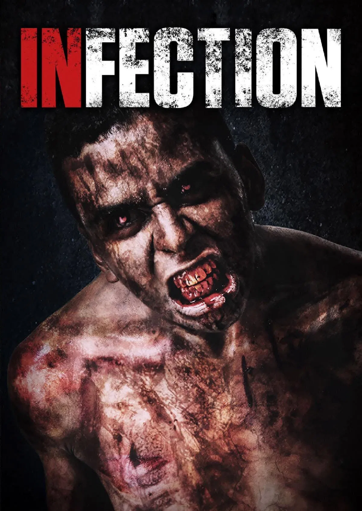 عفونت (Infection)